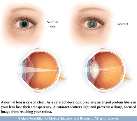 Cataract Diagram